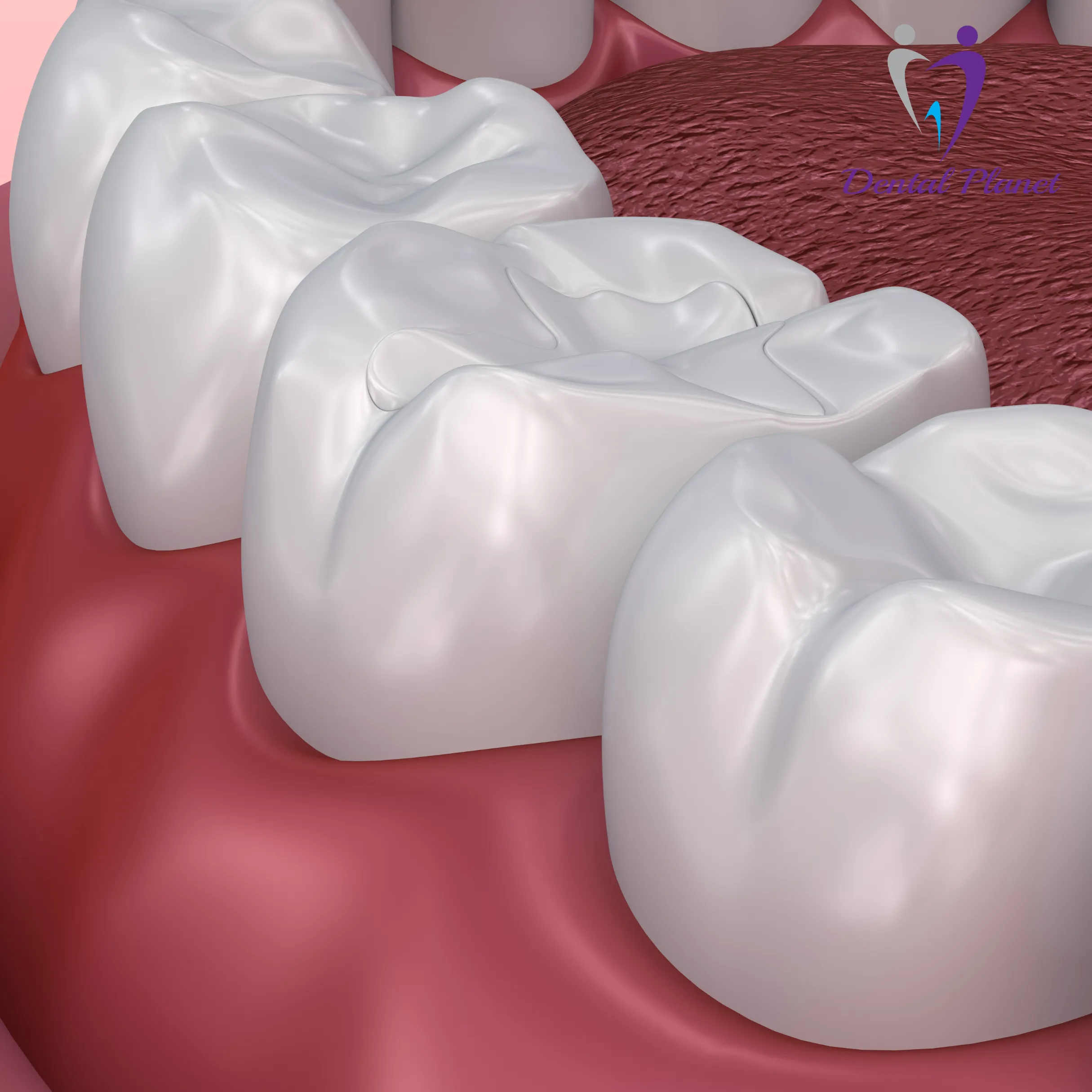 Pit and Fissure Sealants - Dental Planet